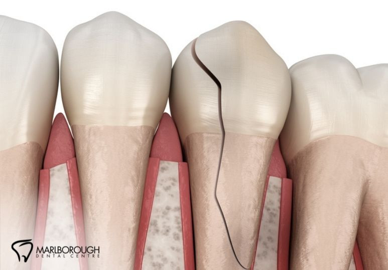 3 Things You Should NEVER Do in a Dental Emergency